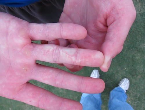 Staver shows the scar from the surgery on the ring finger on his right hand. Photo by Mike Capshaw